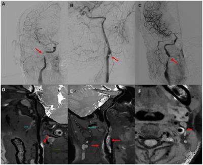 Altered expression of circular RNA in patients with cervical artery dissection